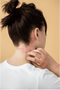 Acupuncture for Rashes 03